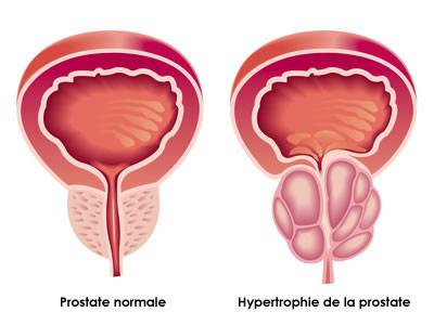 traitement hypertrophie prostate vidal