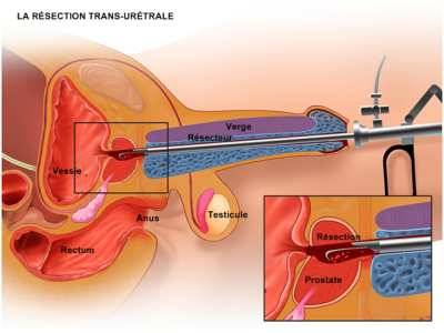 chirurgie de prostata pret tratament prostatita