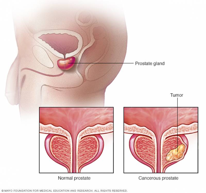 Cancer de prostate