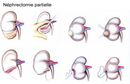 specialiste tumeur du rein